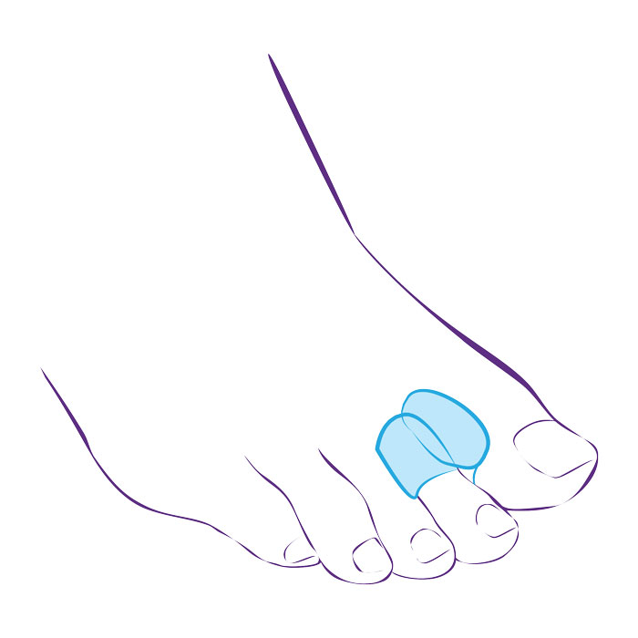 Перегородка межпальцевая с петлёй на второй палец стопы